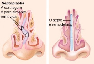 Septoplastia_Dr_Luiz_Cantoni