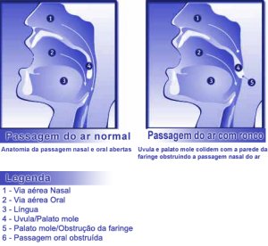 Palatoplastia_Dr_Luiz_Cantoni